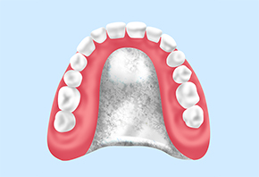金属床入れ歯（自費入れ歯）