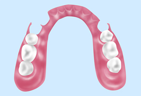ノンクラスプデンチャー（自費入れ歯）